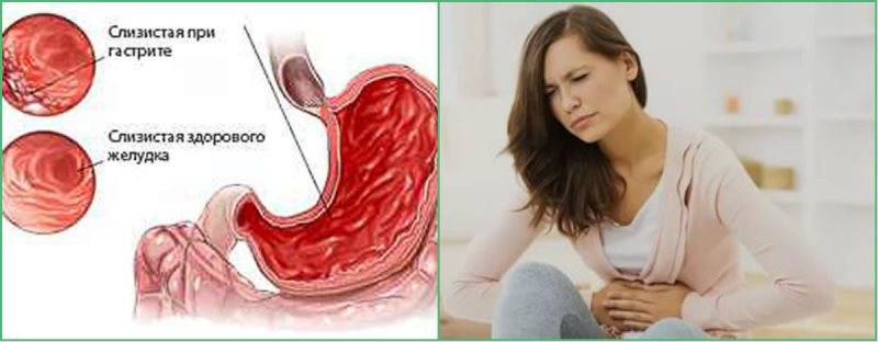gastrit
