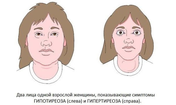 shchitovidka gipo giper